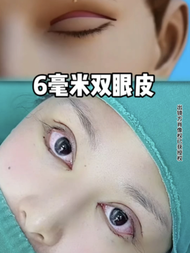 龍巖第二醫(yī)院割雙眼皮多少錢(qián)？收費(fèi)3000-8000元，想一勞永逸的寶子沖這個(gè)！