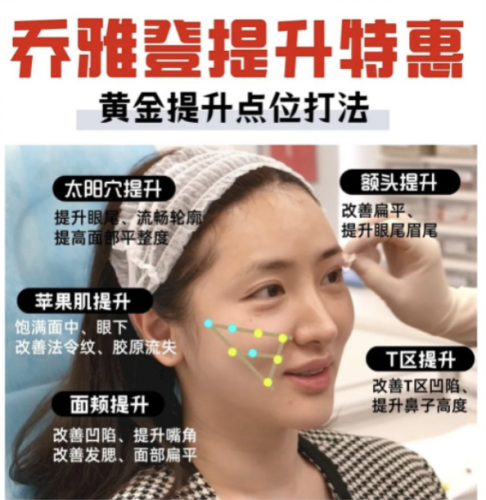 喬雅登注射提升打法：火出圈的變美秘籍！