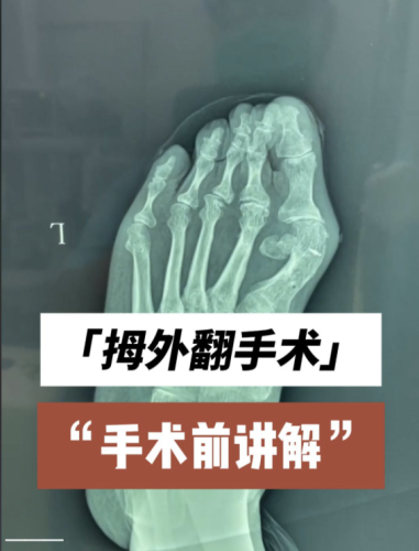大腳骨手術(shù)后遺癥有哪些？提前了解這些坑，術(shù)前能少踩雷