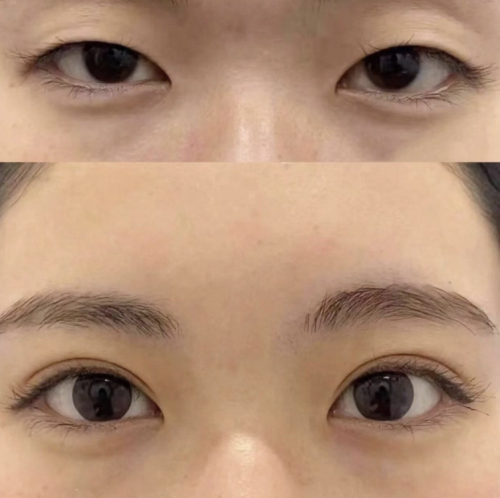 安徽醫(yī)科大學(xué)第一附屬醫(yī)院割雙眼皮多少錢？妥妥的“物超所值”！