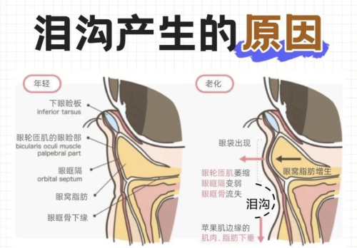 淚溝的形成原因及解決方法？  醫(yī)美治療是快速有效的選擇
