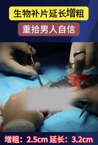 生物補片增粗成功案例：實現(xiàn)陰莖增粗的效果