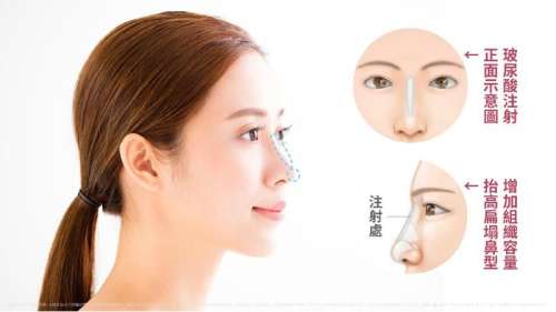 玻尿酸隆鼻的危害有哪些？先看看這幾點(diǎn)再?zèng)Q定也不遲