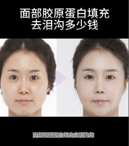 填淚溝多少錢？受到多種因素的交織影響