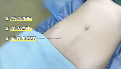 腰腹環(huán)吸加黃金微雕多少錢？案例展示