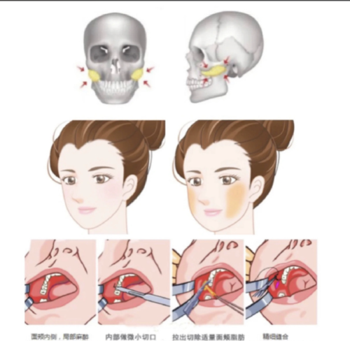 頰脂墊去除會(huì)引起面部下垂嗎？謹(jǐn)慎選擇、規(guī)范操作、做好護(hù)理，降低下垂風(fēng)險(xiǎn)
