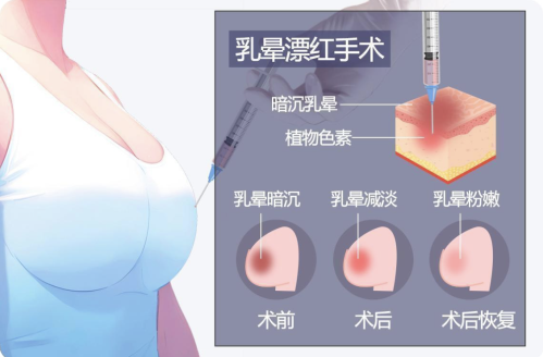 乳頭飄紅大概多少錢(qián)？建議多咨詢幾家機(jī)構(gòu)，謹(jǐn)慎對(duì)待才能更放心