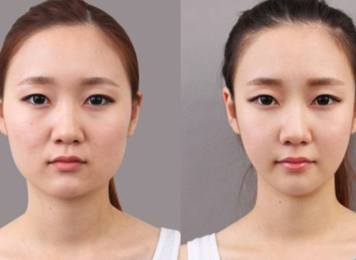 磨下頜角有后遺癥嗎？科學(xué)認(rèn)識磨下頜角手術(shù)