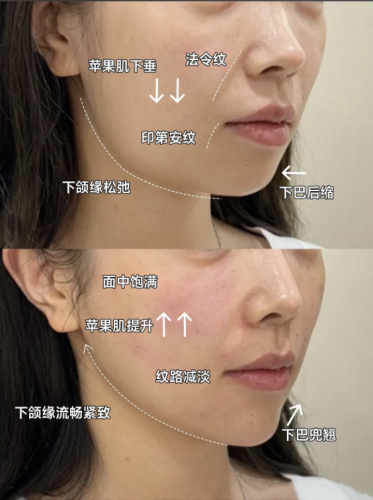 內(nèi)輪廓固定提升能保持多久時(shí)間？實(shí)現(xiàn)美麗直接“超長(zhǎng)待機(jī)”！