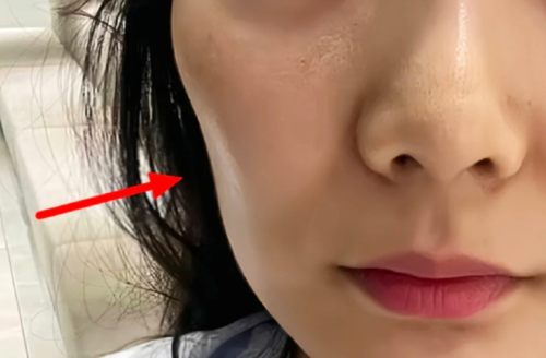 面部凹陷填充能維持多久？揭秘影響時(shí)長(zhǎng)的關(guān)鍵因素