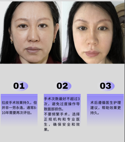 上海新華醫(yī)院拉皮除皺多少錢？不同術(shù)式價格能差出一輛代步車！