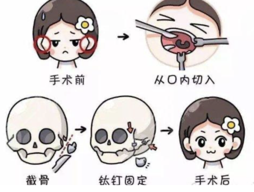 磨骨手術(shù)風(fēng)險(xiǎn)大嗎？需要多少錢？全面了解一下手術(shù)風(fēng)險(xiǎn)程度及費(fèi)用情況