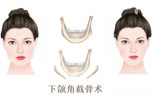 切下頜角會(huì)不會(huì)下垂？全面解析下頜角整形的那些事? ?