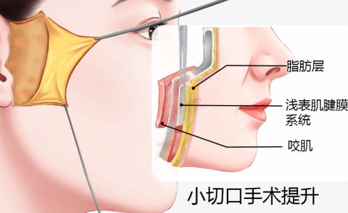 拉皮手術(shù)能維持幾年？所有人都能做嗎