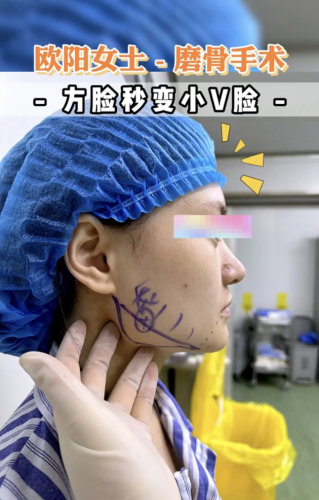 磨下頜角效果好嗎？讓面部更和諧對(duì)稱，提升整體美感