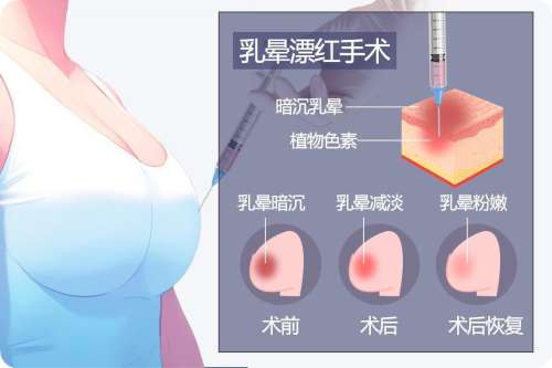 乳頭飄紅要打麻藥嘛，影響痛感的3個關(guān)鍵因素你必須知道