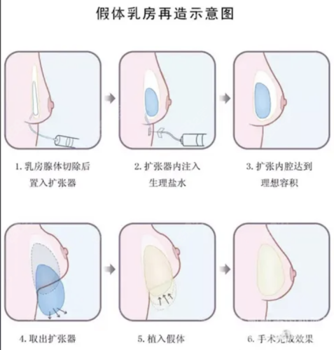 北京地壇醫(yī)院豐胸手術(shù)怎么樣？強大的醫(yī)生陣容為開展豐胸手術(shù)奠定了堅實基礎(chǔ)