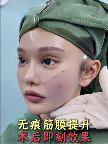 做筋膜提升術多少錢？好好嘮嘮這手術的收費門道