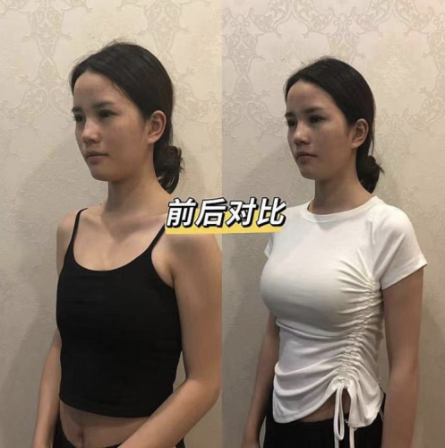 新余人民醫(yī)院隆胸多少錢(qián)？從手術(shù)方式到具體花費(fèi)，給大家做個(gè)詳細(xì)說(shuō)明