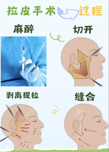 河北省滄州中西醫(yī)結(jié)合醫(yī)院拉皮除皺多少錢？結(jié)合自己的面部情況、預(yù)算，選最適合自己的方案