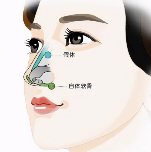 中山第二人民醫(yī)院隆鼻價格：看完這篇直接拿捏預算