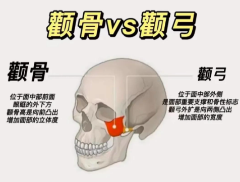 顴弓內推和顴骨內推的區(qū)別：別再傻傻分不清！這倆手術差的不只是“兩個字”