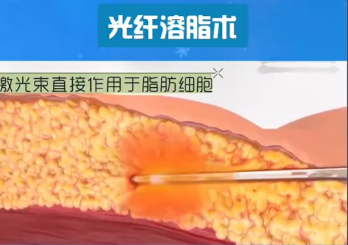 射頻溶脂和光纖溶脂區(qū)別：溶脂不是 “一刀切”，選錯方式可能白花錢還留疤